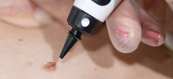 After Skin Tag Removal Sevenoaks