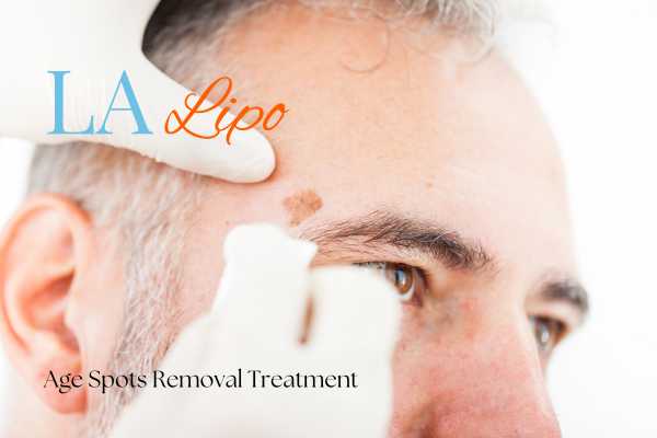 What Are the Most Effective Treatments for Age Spots Sevenoaks?