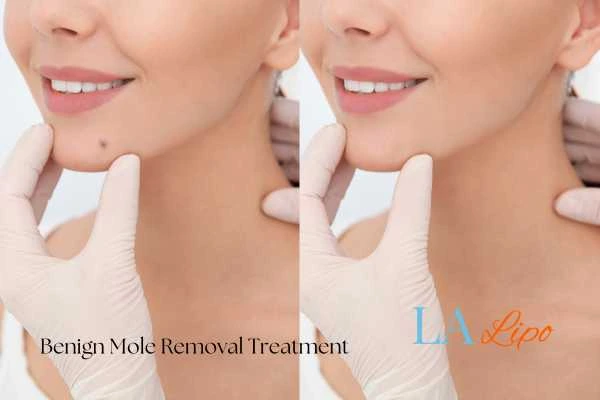 woman's before and after mole removal Sevenoaks results