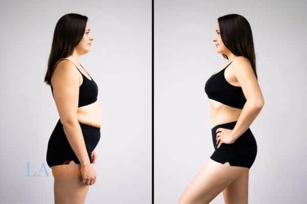 image of woman before and after results of LA-EMS Body Sculpting Sevenoaks to help treat Diastasis recti