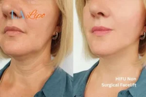 hi-fu for wrinkles Sevenoaks before and after results