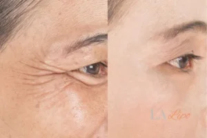 Before and after results of woman - HI-fu wrinkles reduction treatment Sevenoaks