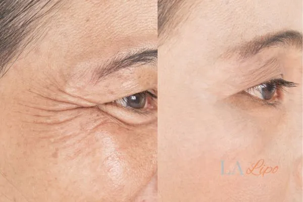Before and after results of woman - HI-fu wrinkles reduction treatment Sevenoaks