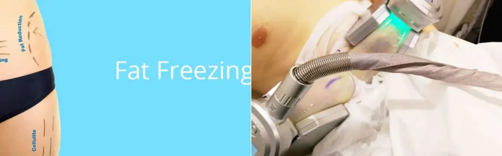Fat freezing Sevenoaks on multiple areas of the body