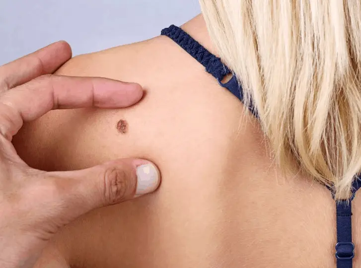 woman having mole removal Sevenoaks consultation before treatment.