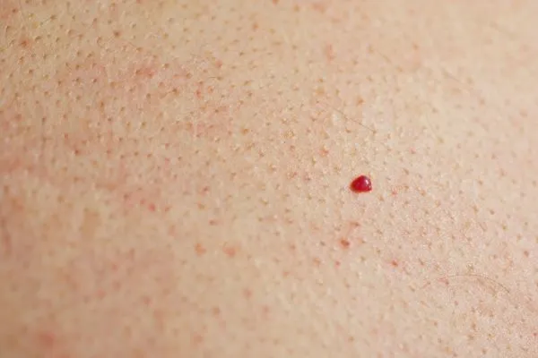 close up of a cherry angioma Sevenoaks