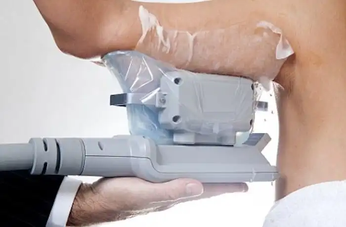 Picture of fat freezing Sevenoaks on the upper arms.