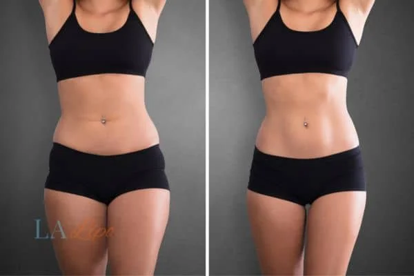 before and after results of non-surgical treatment to help a woman's body image and mental health Sevenoaks