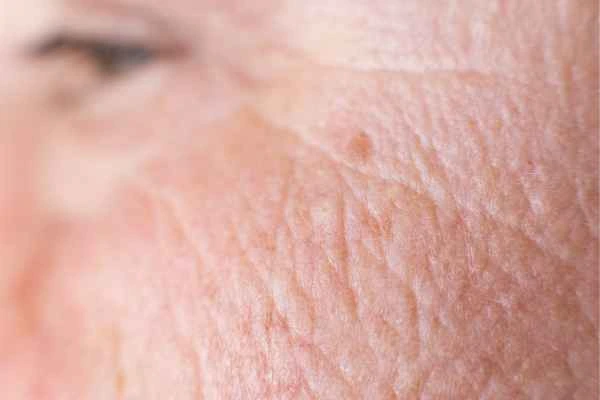 close up picture of a woman's face showing an age spot Sevenoaks