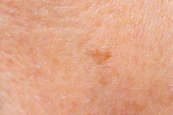 close up picture of age spots Sevenoaks