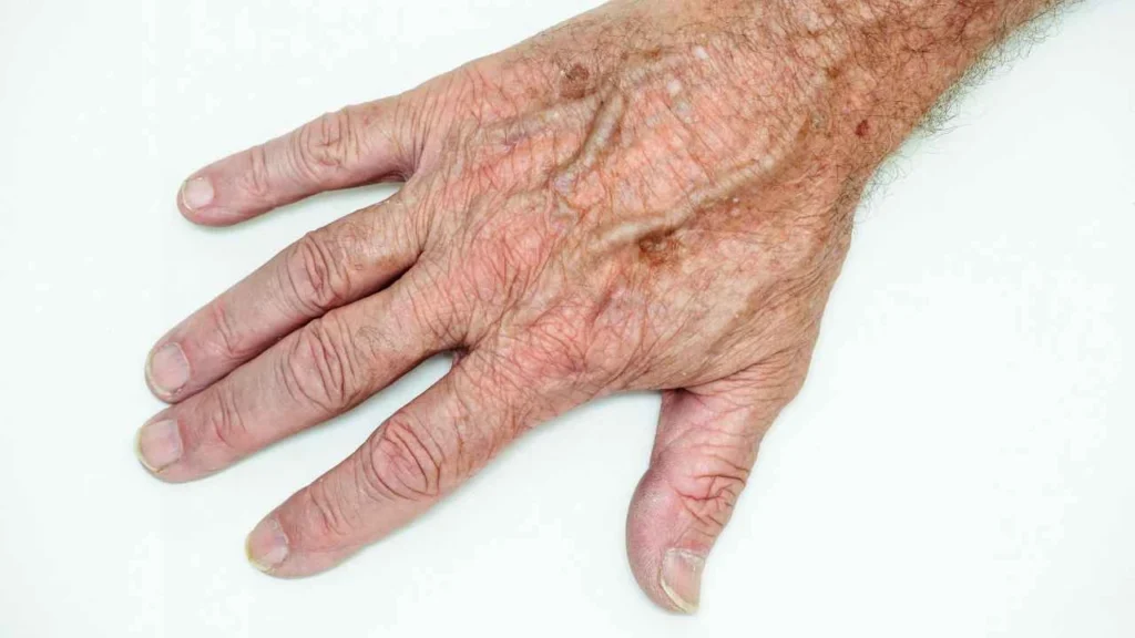 Male hand showing age spot Sevenoaks