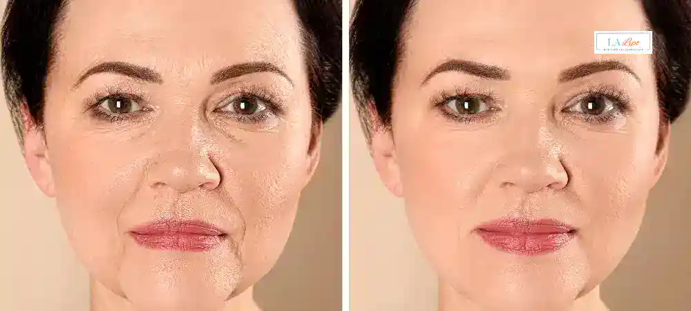 How Long Does It Take to See Results and How Long Do They Last Sevenoaks?